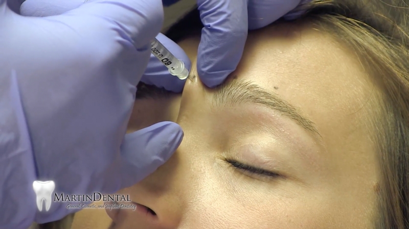 Botox Martin Dental Eau Claire